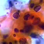 Δοκιμασία Lugol